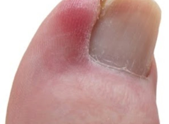 Ingrown Toenail Treatment in Toenail Fungus Treatment Center - Los Angeles, CA