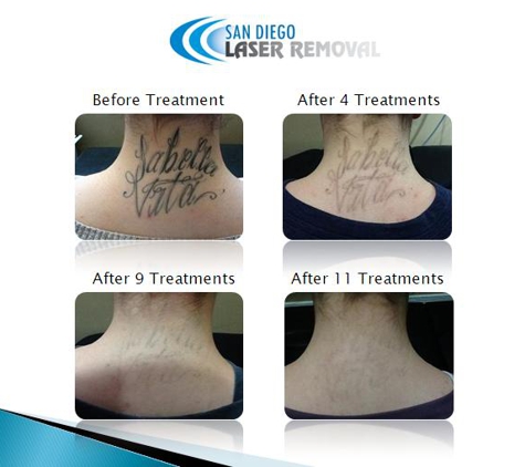 San Diego Laser Removal - San Diego, CA