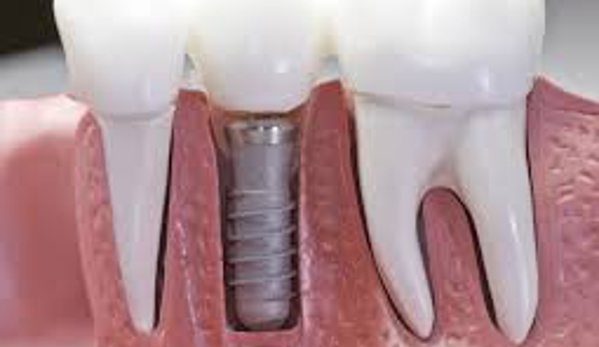 Middlebury Dentist - Middlebury, CT. Is a dental implant in your future?