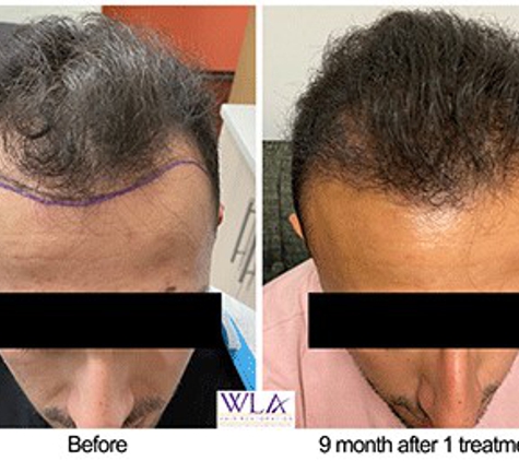 West LA Hair Restoration - Los Angeles, CA