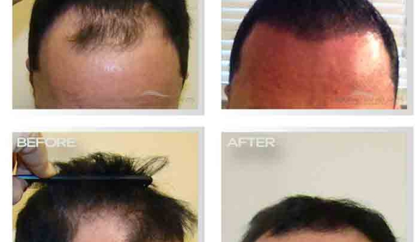 Natural Transplant, Hair Restoration Clinic MIAMI - Miami, FL