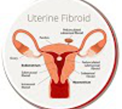 USA Fibroid Centers - West Hollywood, CA