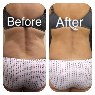 All About You Spa and Fitness - Oklahoma City, OK. Before and After LPG Endermologie