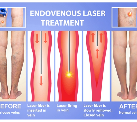 Dr. Jawdat J Abboud, MD - Palos Hills, IL. EVLT for varicose veins treatment