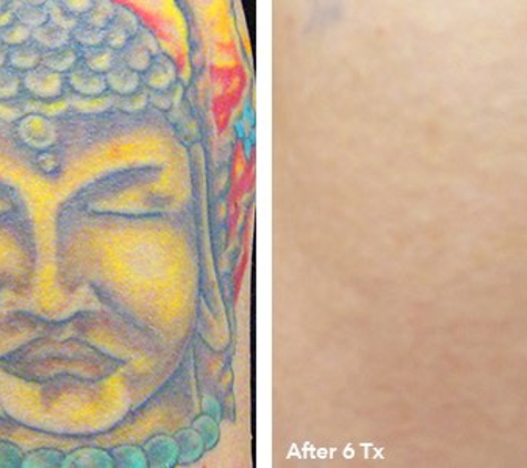 Eraser Clinic Laser Tattoo Removal - Austin, TX