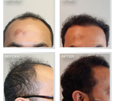 Natural Transplant, Hair Restoration Clinic MIAMI - Miami, FL