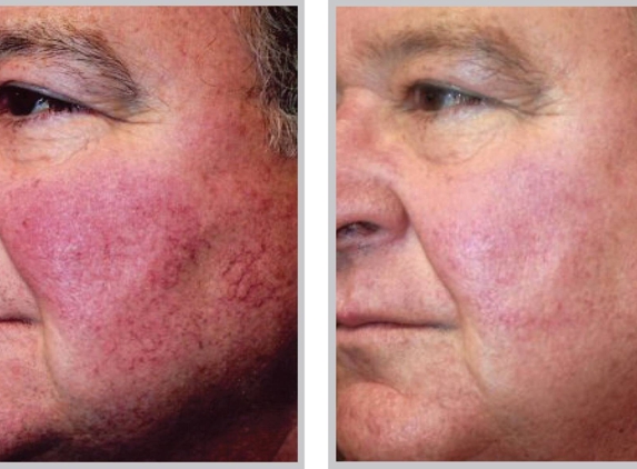 Rejuvenation by Lazaderm - Sioux City, IA. See the difference