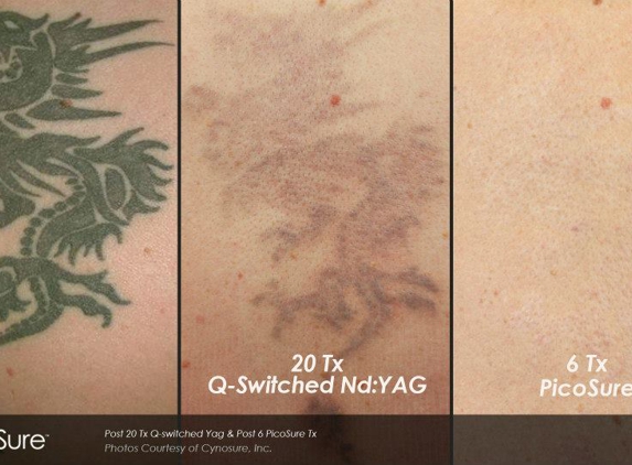 Phoenix Tattoo Removal - Phoenix, AZ