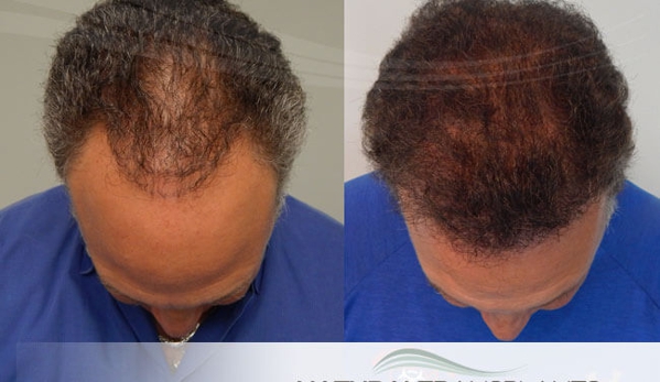 Natural Transplants, Hair Restoration Clinic - Fort Lauderdale, FL