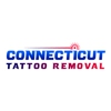 Connecticut Tattoo Removal gallery
