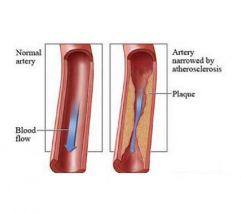 USA Vascular Centers - Morgantown, WV