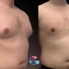 Gynecomastia Surgery Center in Los Angeles
