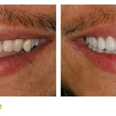 Salt Lake Dental Care - Clint Blackwood DDS - Teeth Whitening Products & Services