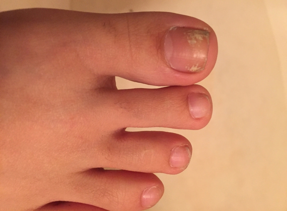 A Plus Nails - Henderson, NV. R foot nail fungus