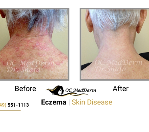 Oc Medderm - Irvine, CA. Eczema Skin Disease