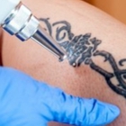 Lexington Tattoo Removal