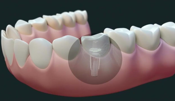 Beacon Place Dental Group - Brookline, MA. Treatment with dental implants is the preferred method to restore missing teeth, as they offer a permanent solution that prevents bone loss.