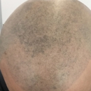 Scalp Aesthetics - Hair Replacement