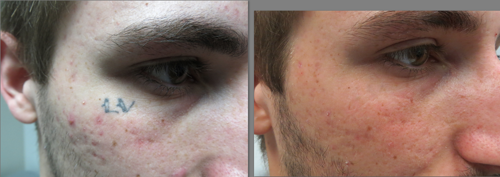 Clear Out Ink Laser Tattoo Removal LLC 2610 W Horizon