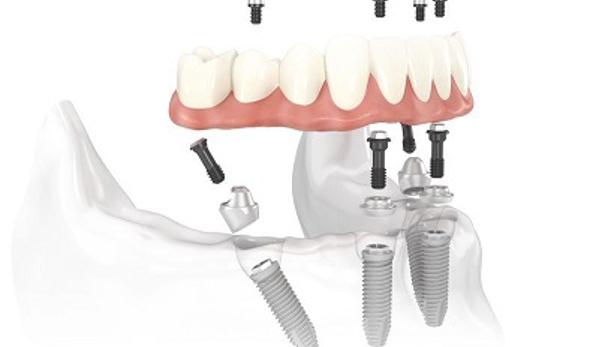 Chandler Dental Implants & Periodontics - Chandler, AZ