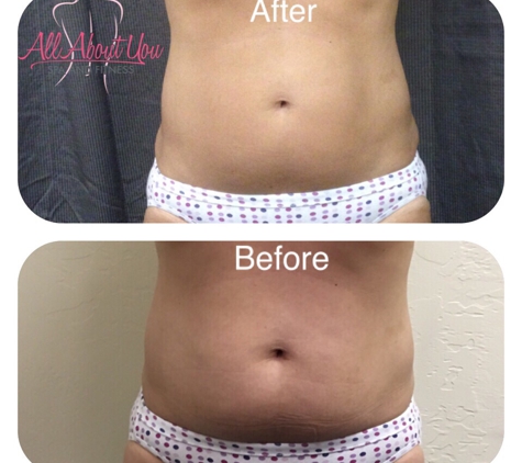 All About You Spa and Fitness - Oklahoma City, OK. Before and After LPG Endermologie