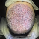 Hairsthetics - Hair Replacement