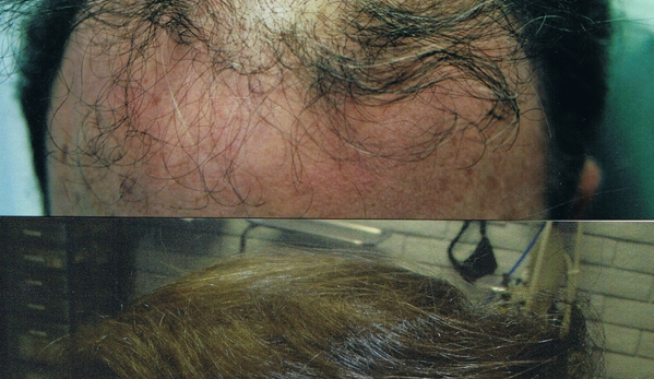 Tampa Bay Hair Restoration - Clearwater, FL
