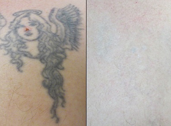 Vanish Laser Tattoo Removal and Skin Aesthetics - Fort Worth, TX