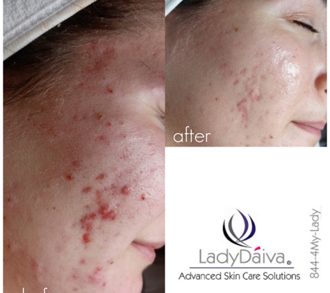 Lady Daiva Skin Care - Fort Myers, FL. Acne Treatment