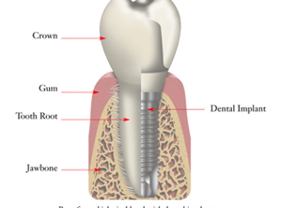 Dental Arts Group - El Cajon, CA. Tooth crown I got at Dental Arts San Diego.