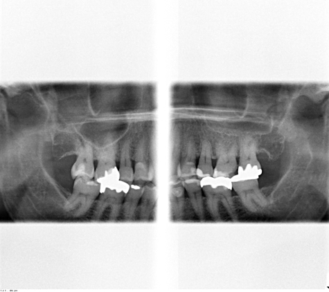 Dental Center Imagining - Oakland, CA. Extra Oral Bitewings