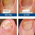 Laser Nail Therapy - Largest Toenail Fungus Treatment Center