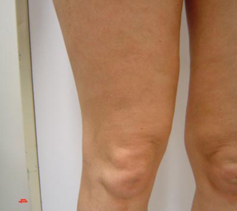 Vein Health Medical Clinic - Melbourne, VIC. VenaSeal Treatment Melbourne