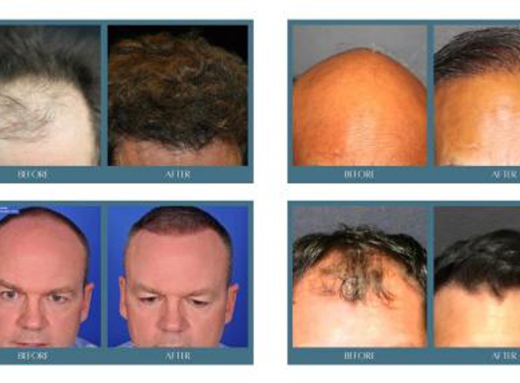 Complete Hair Restoration - Houston, TX