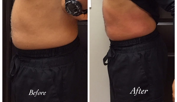 Body Shapers of Houston - Houston, TX. Non-invasive Body Contouring