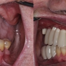 Ammons Dental By Design Downtown Charleston - Implant Dentistry