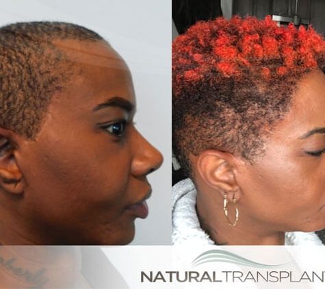 Natural Transplants, Hair Restoration Clinic - Fort Lauderdale, FL