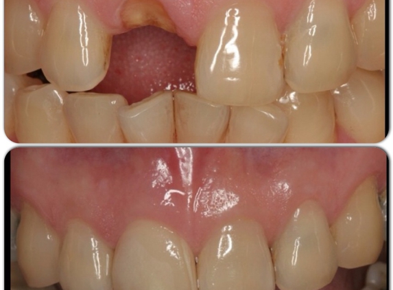 Miracle Smile Dentistry - Coral Gables, FL. Before and after - Denta implants - coral Gables Dentist