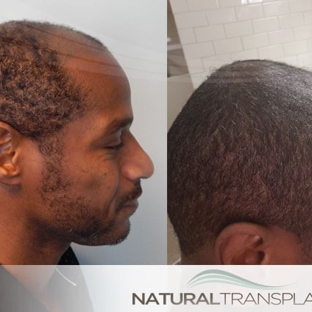 Natural Transplants, Hair Restoration Clinic - Fort Lauderdale, FL