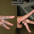 Fade Fast Laser Tattoo Removal