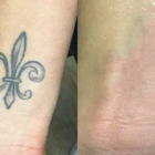 ReversaTatt Tattoo Removal