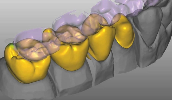 Backer Dental Laboratory - Bakersfield, CA. In house crown design