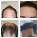 Natural Transplants, Hair Restoration Clinic - Hair Replacement