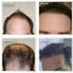 Natural Transplants, Hair Restoration Clinic