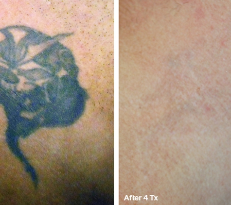 Laser Tattoo Removal by Tatt Cemetery - Fort Myers, FL