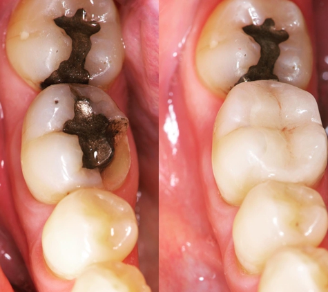 iHeartDDS - Santa Clarita, CA. Restore amalgam with White composite