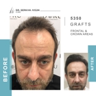 Hair Transplant Turkey | Dr. Serkan Aygin | Miami Branch Office