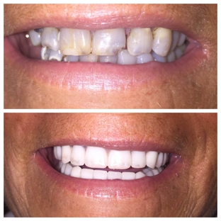 Roach Family Dentistry - Nashville, TN. Before & After