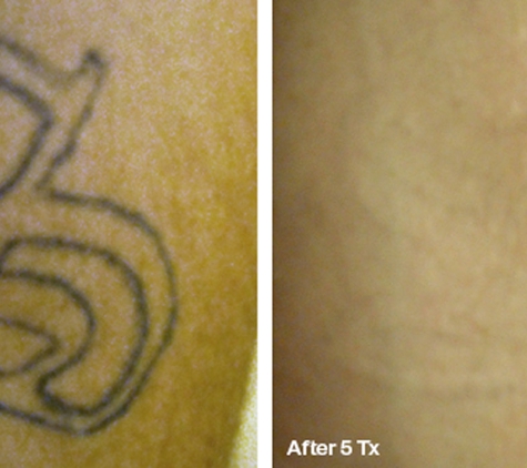 Laser Tattoo Removal by Tatt Cemetery - Fort Myers, FL