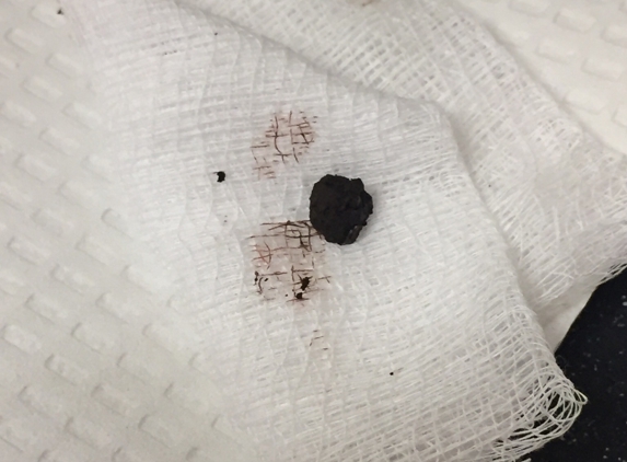 Children's Ear, Nose, and Throat Associates - Orlando, FL. This is the bb that was taken out of his ear.